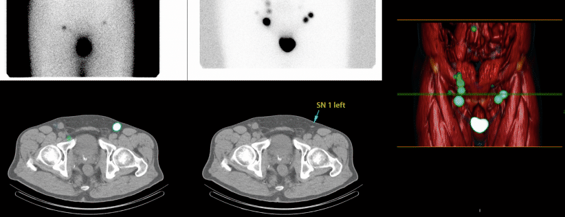 Sentinel node biopsy and lymphatic mapping in penile and prostate ...