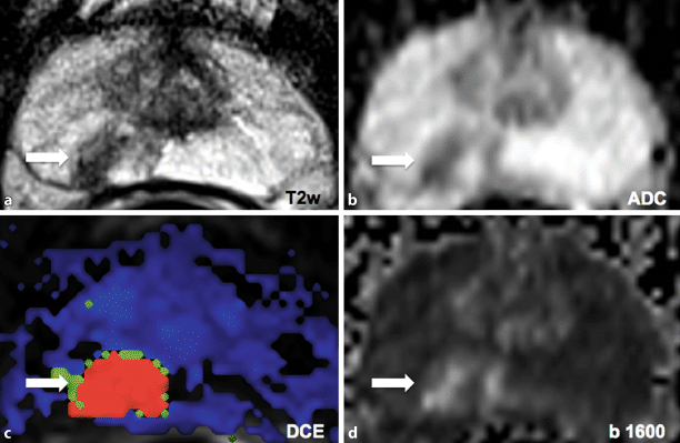 Fokale Therapie Des Prostatakarzinoms Springerlink - 