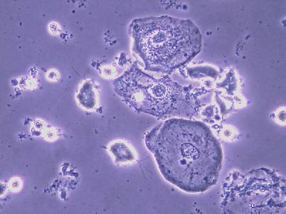 Das Nativpräparat in der Diagnostik gynäkologischer Infektionen