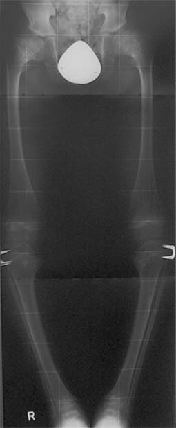 Spondyloepiphysäre und metaphysäre Dysplasie SpringerLink