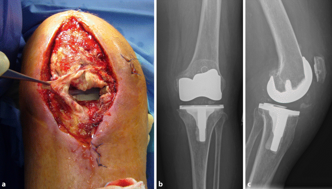 patellasehne abriss patellasehne abriss