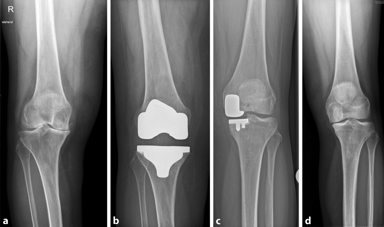 Knie-TEP | Bikondylrer Oberflchenersatz des Kniegelenkes beim jungen  Patienten  ein Update | springermedizin.de
