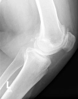 Patellofemoraler Ersatz Und Schlittenprothese Springerlink - 