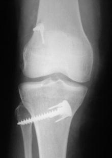 Peroneal nerve damage by bicortical tibial screw in ACL reconstruction