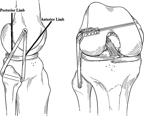 Combined PCL and PLC reconstruction in chronic posterolateral ...