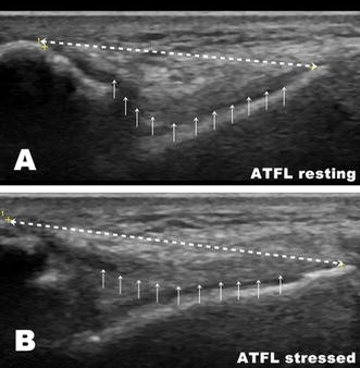 Value of stress ultrasound for the diagnosis of chronic ankle ...