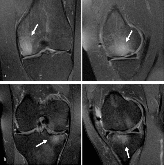 Bone marrow lesions and subchondral bone pathology of the knee ...