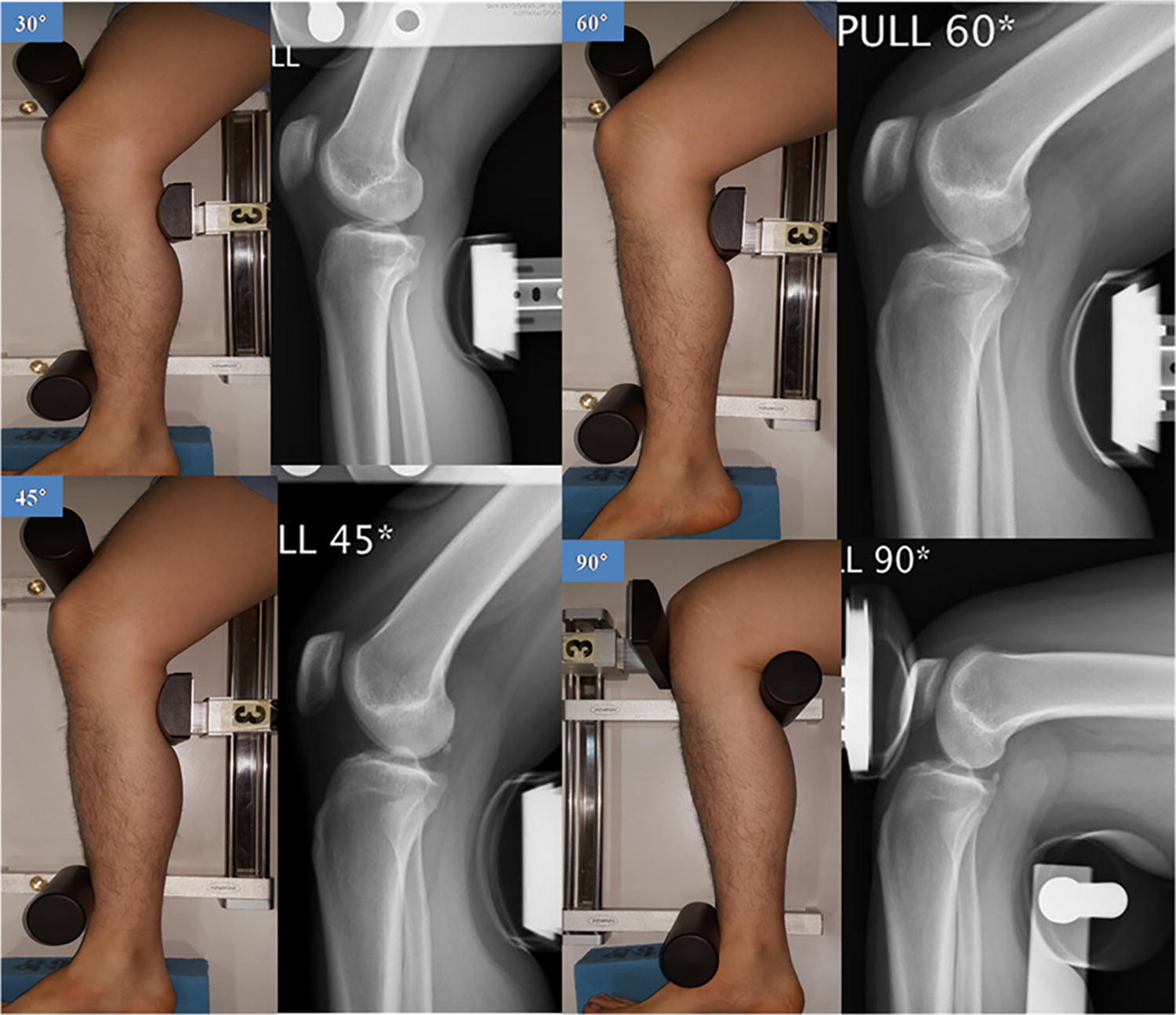 Stress Radiography At 30 Of Knee Flexion Is A Reliable Evaluation