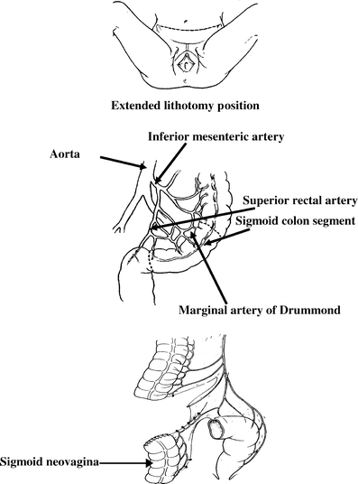 Vaginal Reconstruction With Sigmoid Colon In Vaginal Agenesis Springerlink