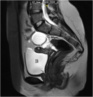 Congenital vesicovaginal fistula: spontaneous or forced? Two cases and ...