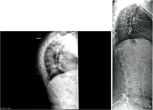 Vertebral fracture assessment by DXA is inferior to X-ray in clinical