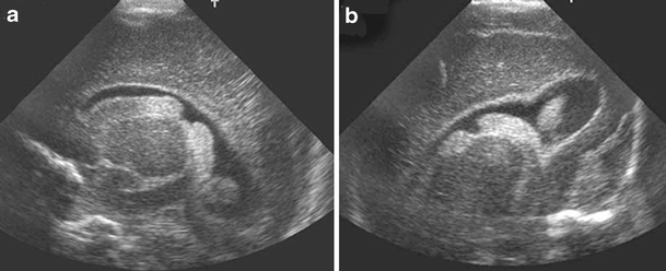 Imaging the premature brain: ultrasound or MRI? | SpringerLink