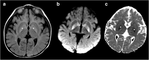 Bilateral symmetrical basal ganglia and thalamic lesions in children ...