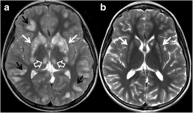 Bilateral symmetrical basal ganglia and thalamic lesions in children ...