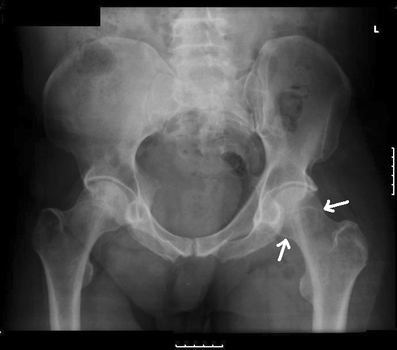 A rare presentation of necrotising fasciitis and myositis with femoral ...