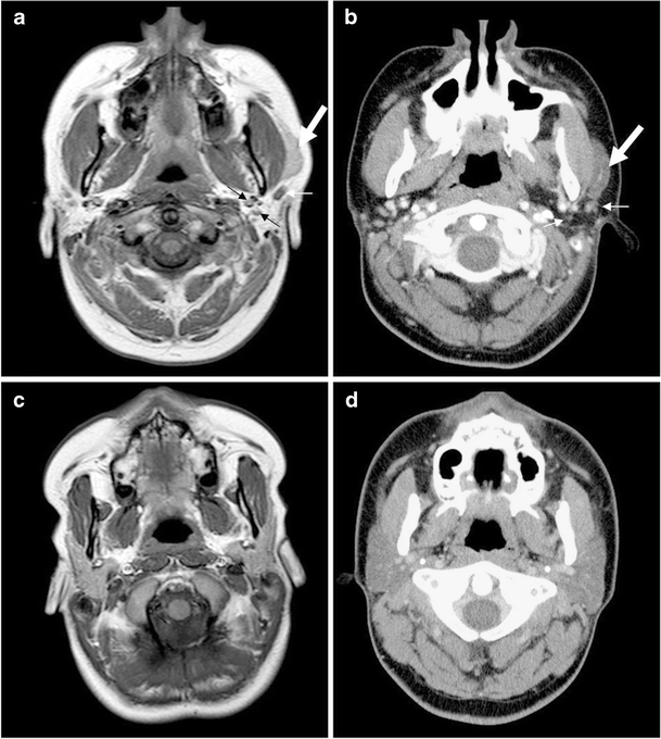 Aplasia of the parotid glands with accessory parotid tissue SpringerLink