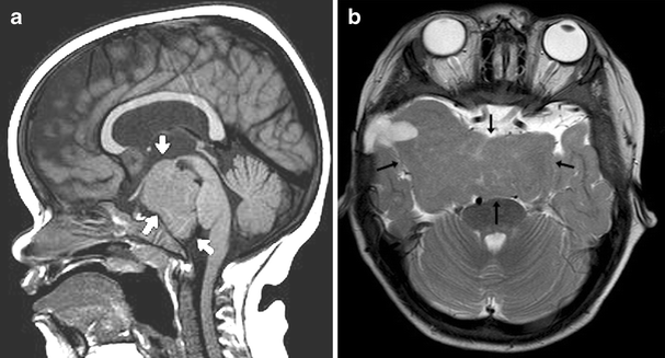 Cochlear abnormality in a case of Pallister-Hall syndrome ...