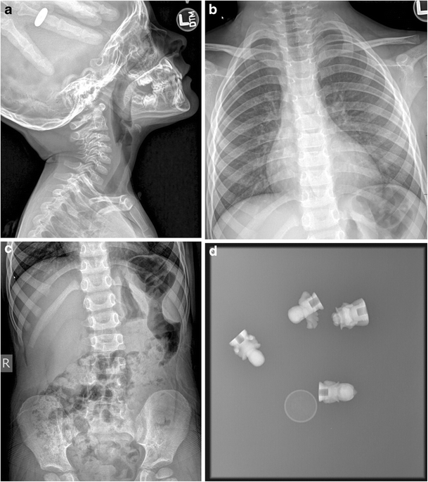 Foreign bodies radiopaque compared to what? SpringerLink
