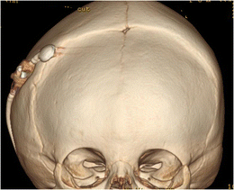 Craniosynostosis: imaging review and primer on computed tomography ...