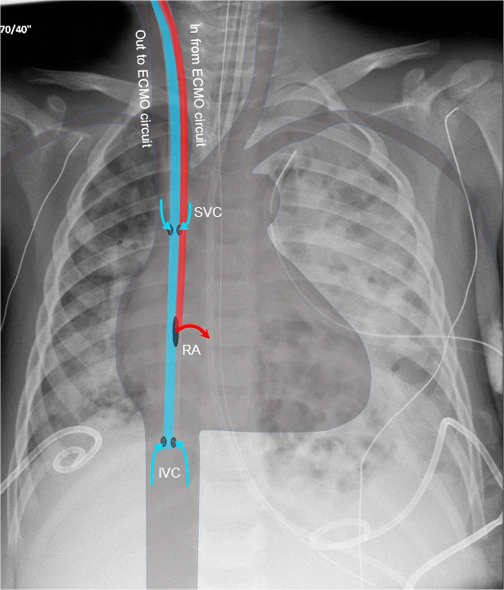 Pediatric extracorporeal membrane oxygenation (ECMO) a guide for