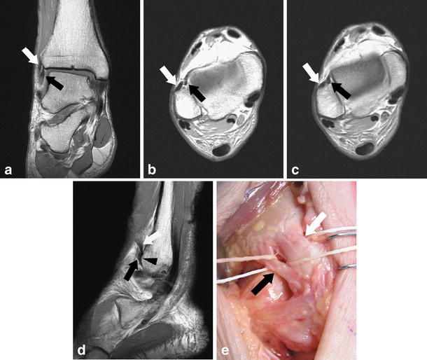 MRI appearance of surgically proven abnormal accessory anterior