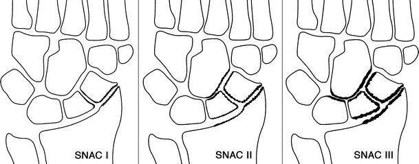 Imaging of radial wrist pain. Part II: pathology | SpringerLink