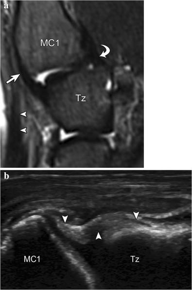 Imaging And Management Of Thumb Carpometacarpal Joint