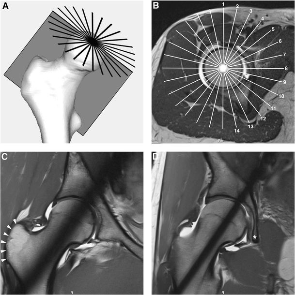 Validation of a standardized mapping system of the hip joint for radial
