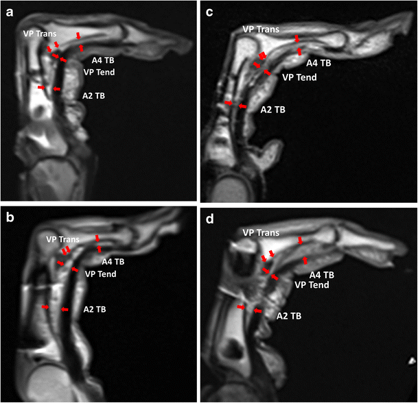 Evaluation of finger A3 pulley rupture in the crimp grip position—a resonance imaging