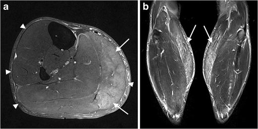 Hoffmann’s disease: MR imaging of hypothyroid myopathy | SpringerLink