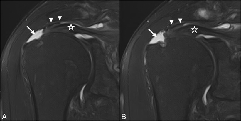 Multimodality imaging of subacromial impingement syndrome | SpringerLink