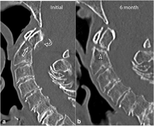 type 3 odontoid fracture type 3 odontoid fracture