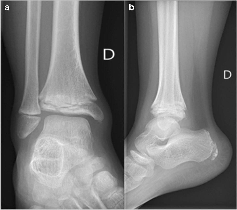 acute-right-ankle-pain-in-a-9-year-old-boy-without-history-of-trauma