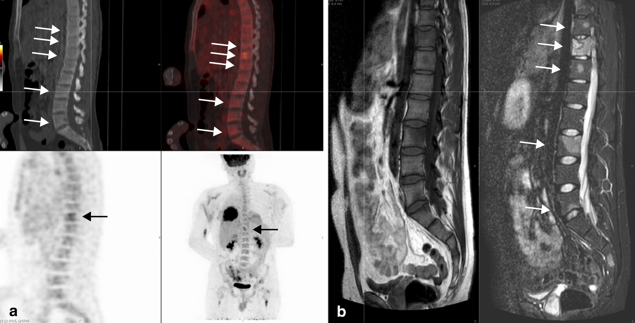 18F-FDG PET-CT versus MRI for detection of skeletal metastasis in Ewing ...