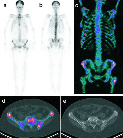Whole-body SPECT/CT for bone scintigraphy: diagnostic value and effect ...