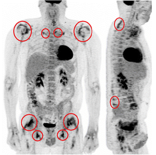 Value of 18F-FDG PET/CT for therapeutic assessment of patients with ...