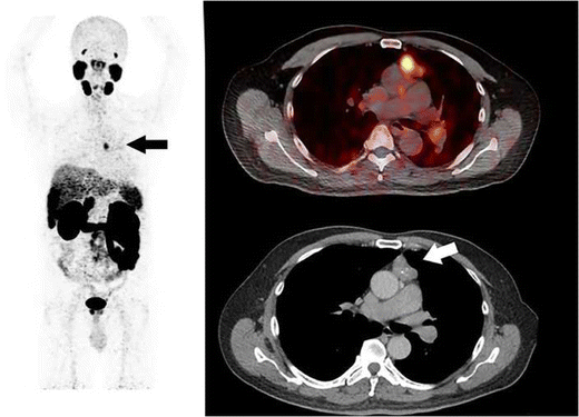A Rare Case Of Thymoma First Detected On Gallium 68 Psma Pet - 