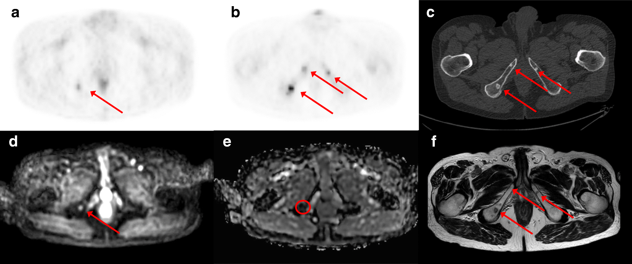 Prospective comparison of 68Ga-PSMA PET/CT, 18F-sodium fluoride PET/CT ...