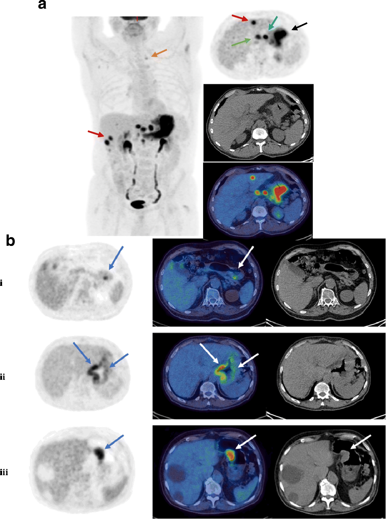Staging FDG PET-CT changes management in patients with gastric ...