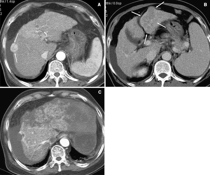 The various manifestations of ruptured hepatocellular carcinoma: CT ...