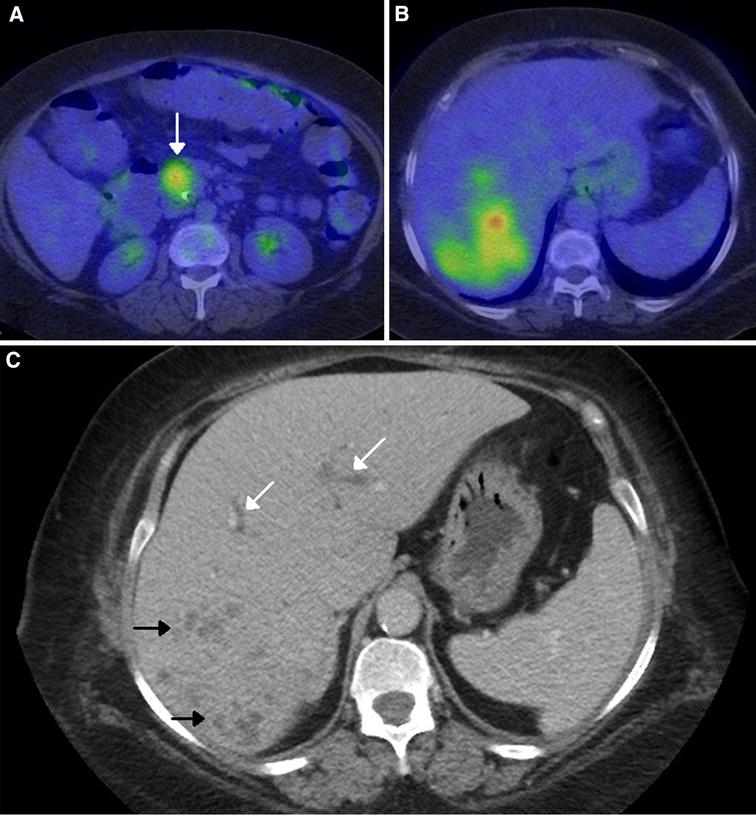 FDG PET/CT in the liver: lesions mimicking malignancies | SpringerLink