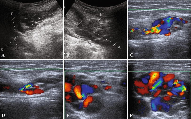 Round ligament varicosities a rare cause of groin swelling in