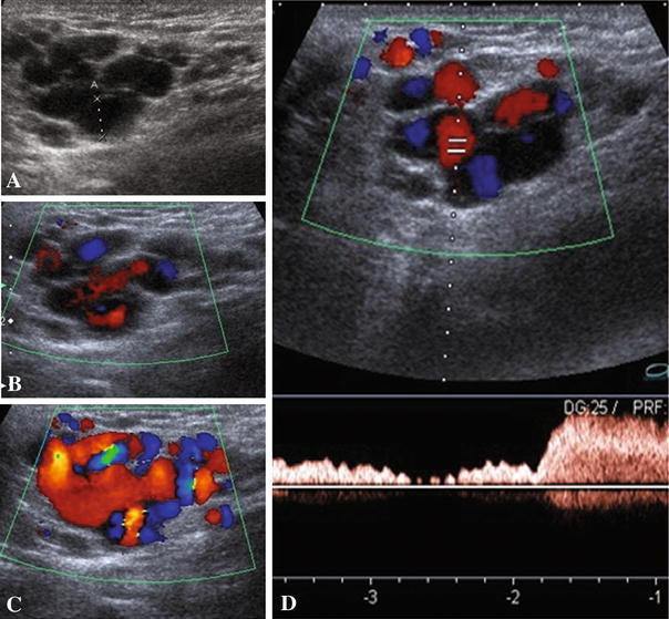 Round ligament varicosities a rare cause of groin swelling in pregnancy SpringerLink