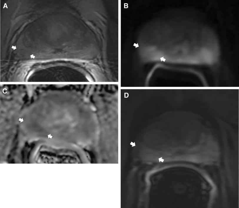 Prostate imaging reporting and data system version 2 (PI-RADS v2): a ...