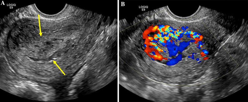 Clinical and imaging predictors of management in retained products of ...