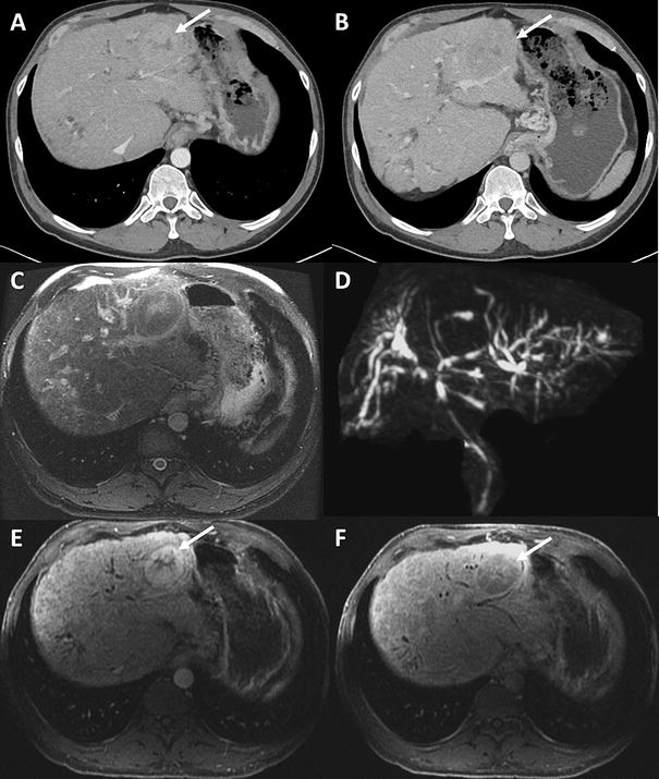 Imaging of autoimmune hepatitis and overlap syndromes SpringerLink