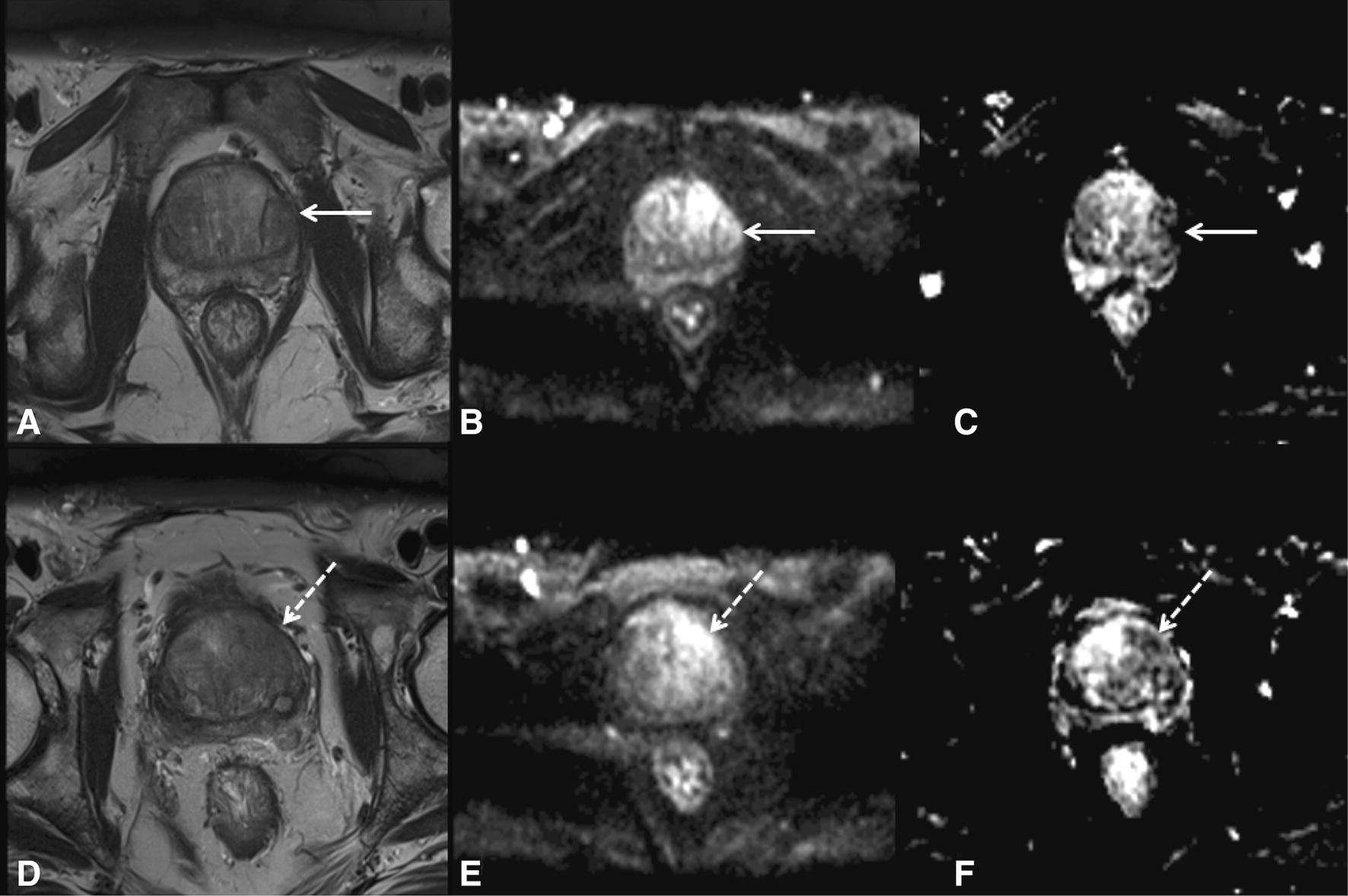 Correlation Of 3t Multiparametric Prostate Mri Using Prostate Imaging Reporting And Data System 6583