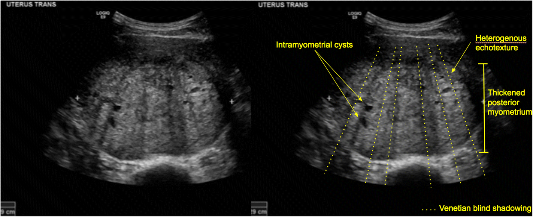 blind shadowing on ultrasound SpringerLink