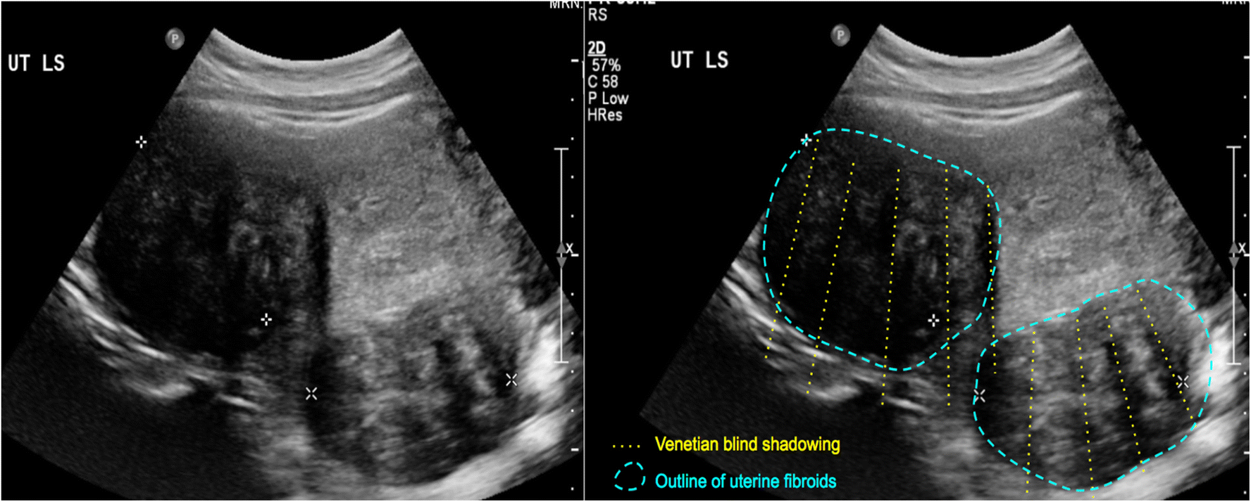 blind shadowing on ultrasound SpringerLink