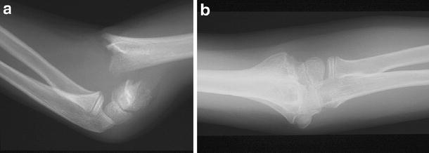 grading supracondylar fracture grading supracondylar fracture
